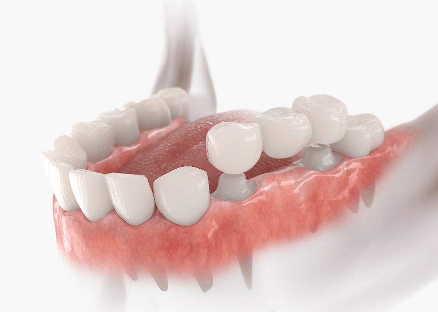 3D-Darstellung einer Zahnbrücke mit Kronen im Unterkiefer – moderner Zahnersatz bei Zahnarzt Dr. Michaela Strumpski, Halle Saale.