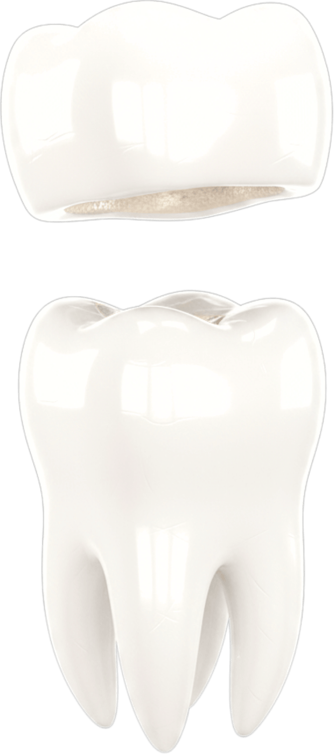 3D-Modell eines Zahns mit eingesetzter Keramikkrone – ästhetischer Zahnersatz in der Praxis für Zahnerhaltung Dr. Strumpski, Halle.