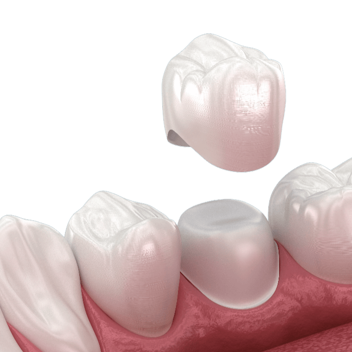 3D-Darstellung einer Keramikkrone über einem präparierten Zahn – moderner Zahnersatz bei Zahnarzt Dr. Strumpski, Halle Saale.
