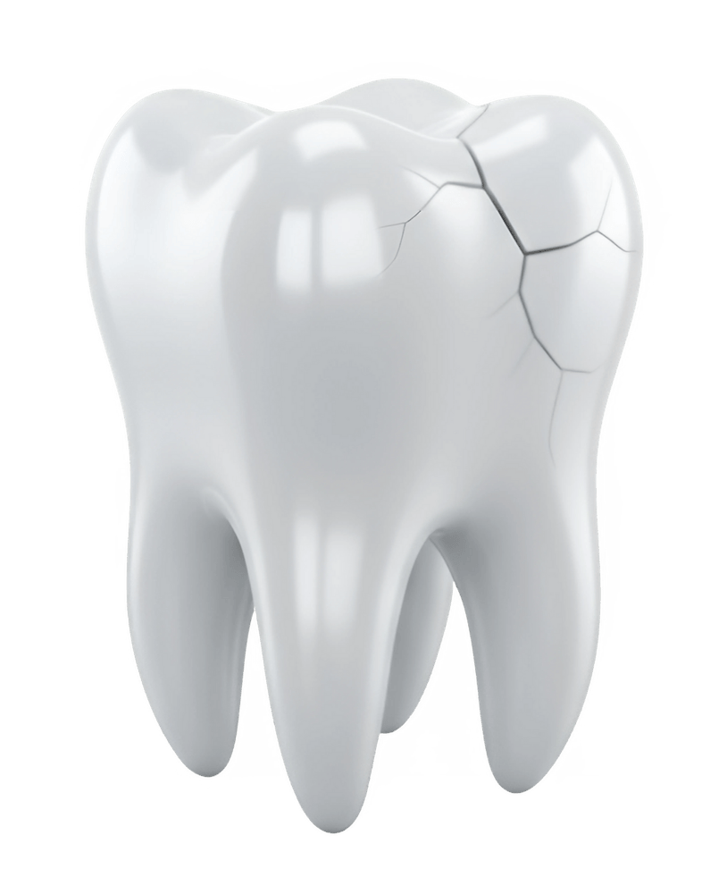 Darstellung eines gesprungenen Zahns – Symbol für Zahntrauma und Soforthilfe in der Praxis für Zahnerhaltung Halle.